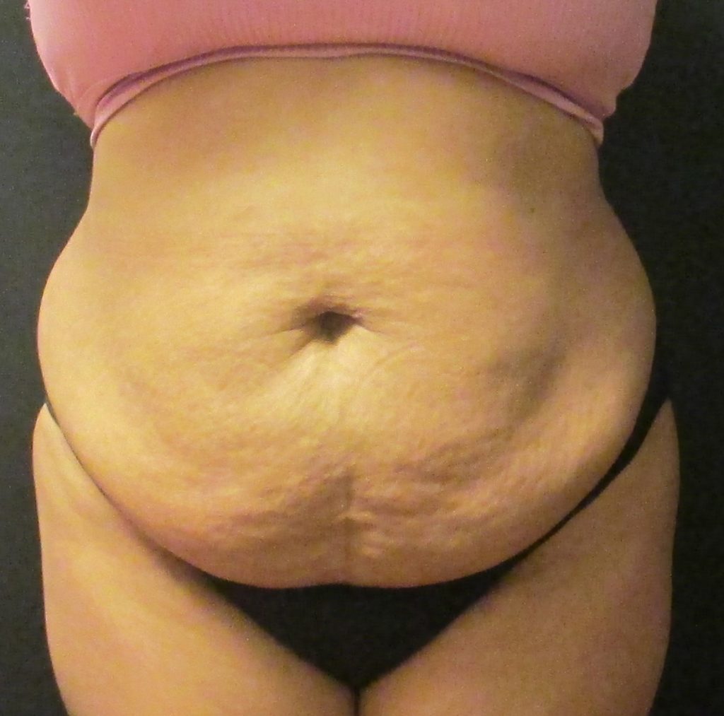 Lipo Surgery Case Id 5000 Pre Latfront