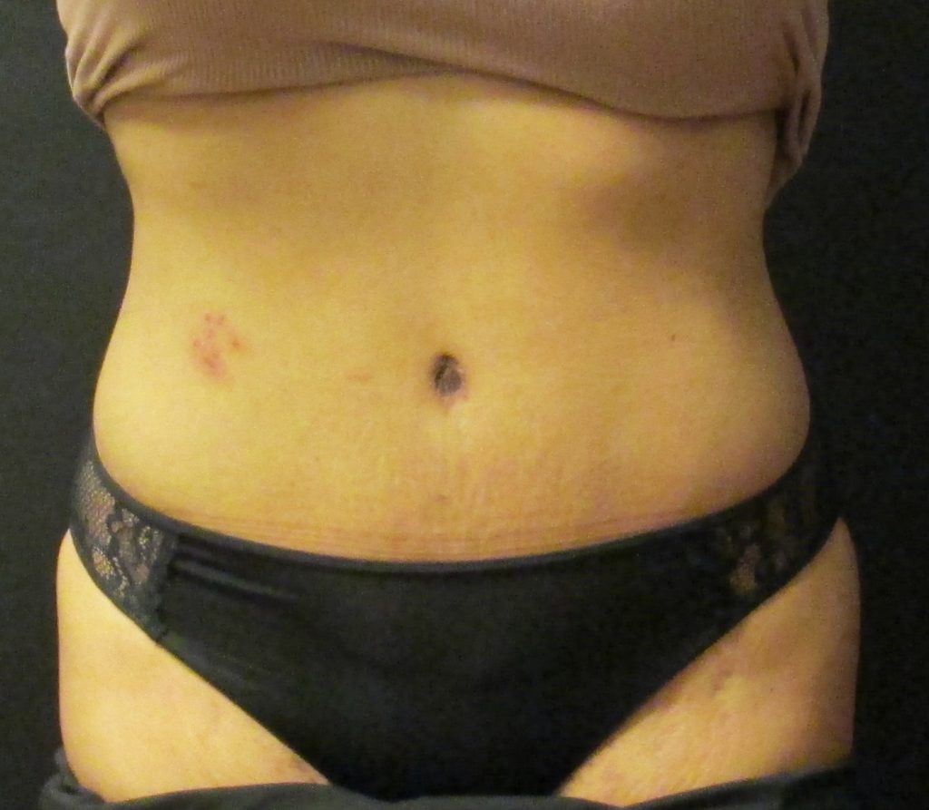 Lipo Surgery Case Id 5001 Post Lat Front