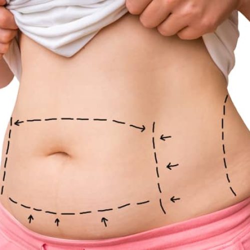 Medical Benefits of a Tummy Tuck